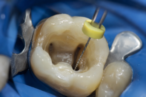 Best Root Canal in Jhansi