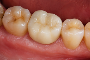 Dental Crown in jhansi